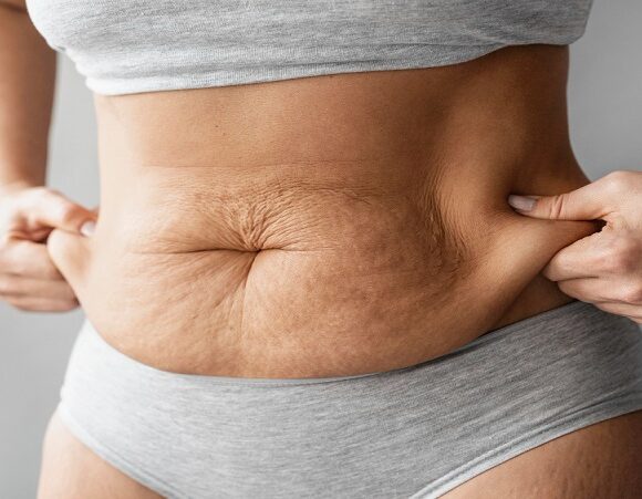 How to Prevent Skin From Sagging When Losing Weight