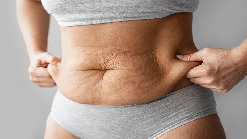 How to Prevent Skin From Sagging When Losing Weight