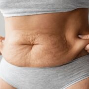 How to Keep Skin From Sagging When Losing Weight
